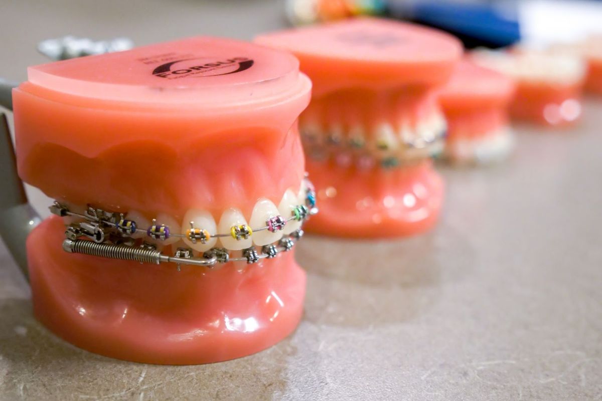 how-much-do-braces-cost